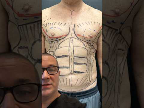 AWAKE LIPO RESULTS