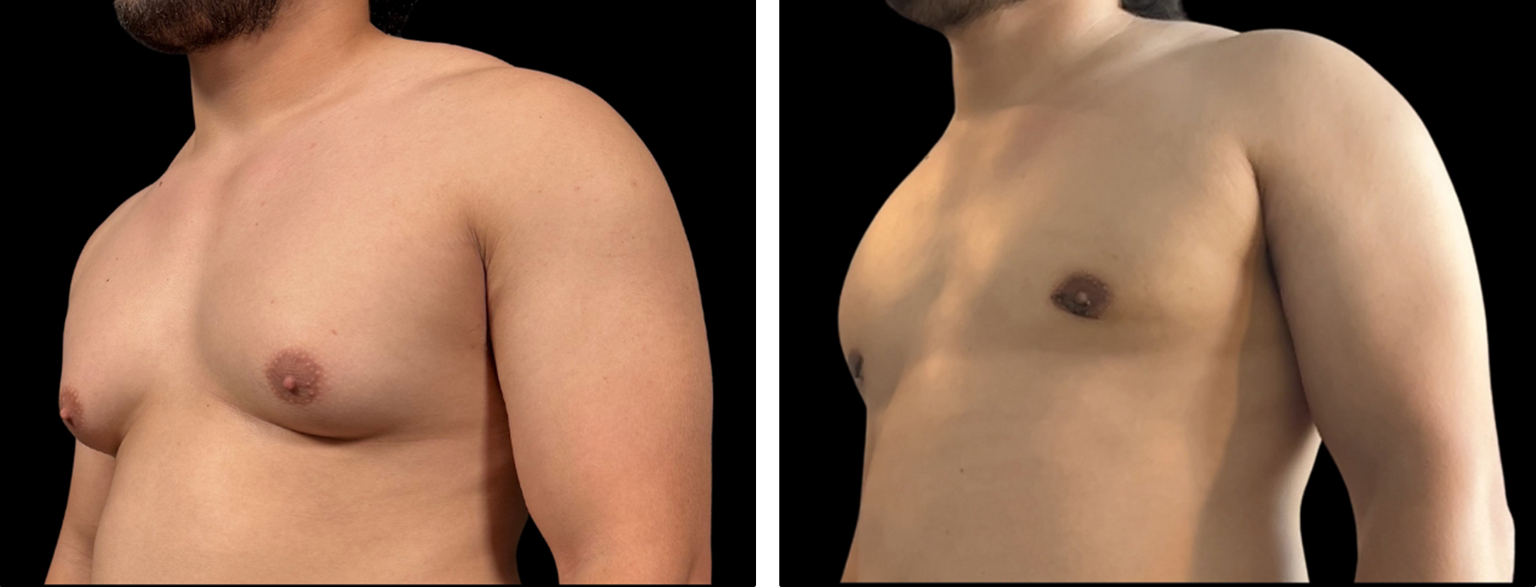 Male chest enhancement before-and-after treatment