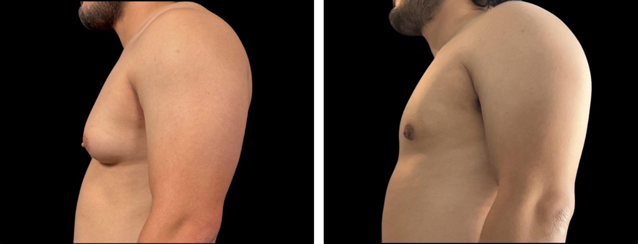 Male upper body contouring side-view comparison