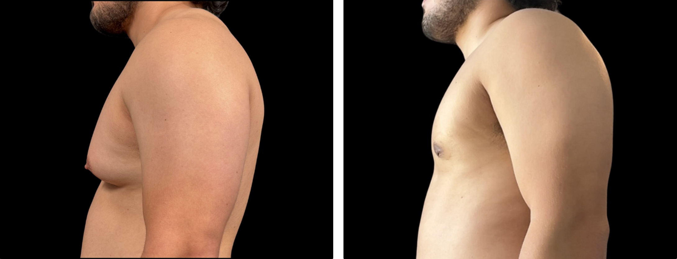 Male chest definition treatment before-and-after