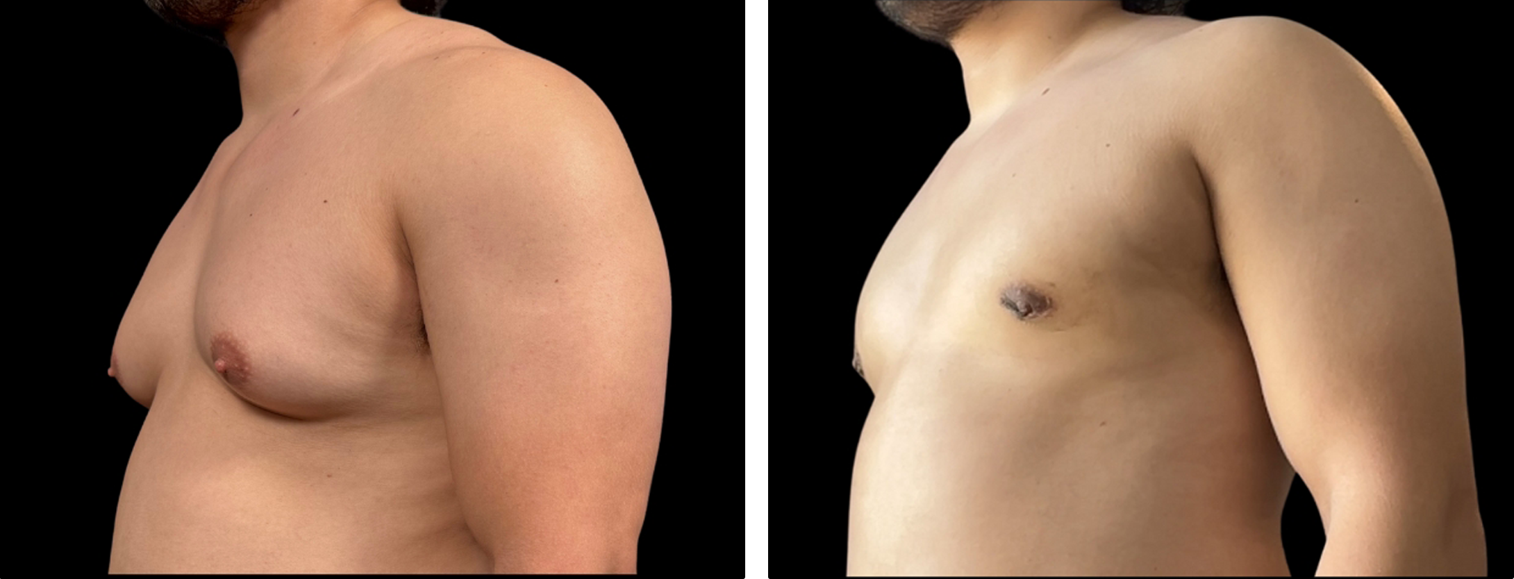 Male torso sculpting before-and-after result