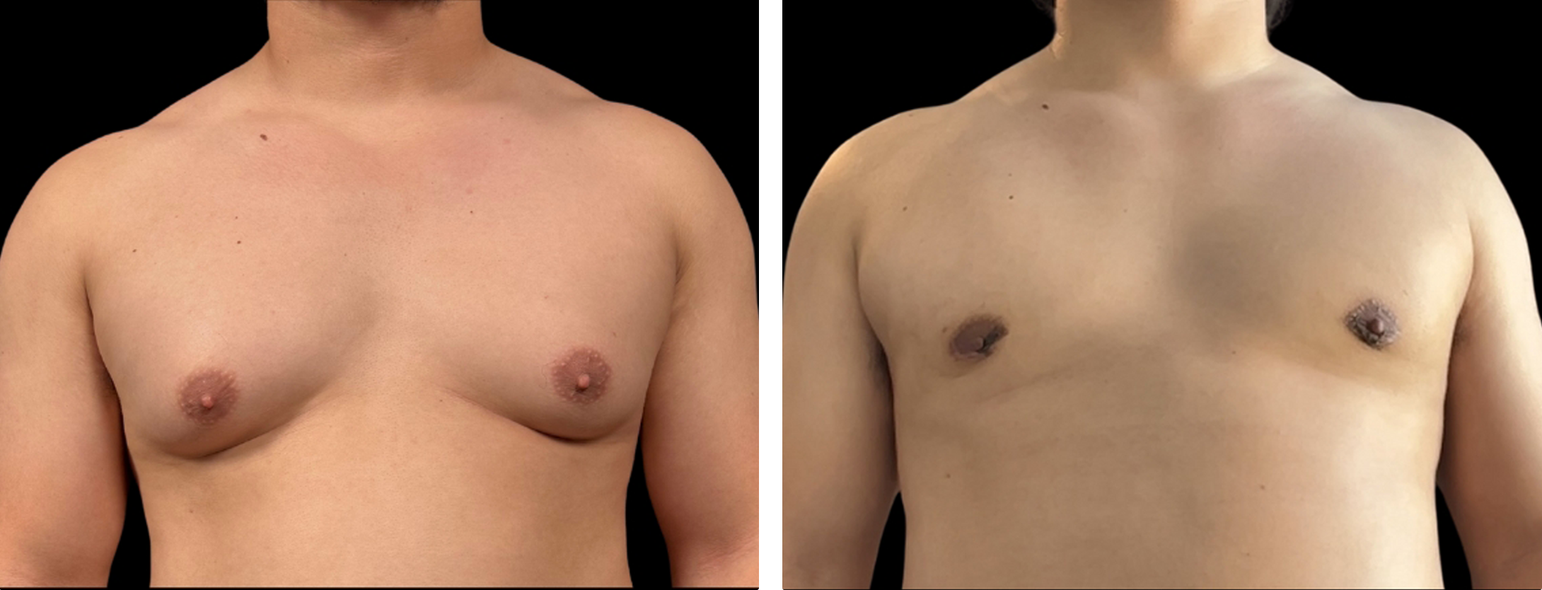 Male chest contouring before-and-after side comparison